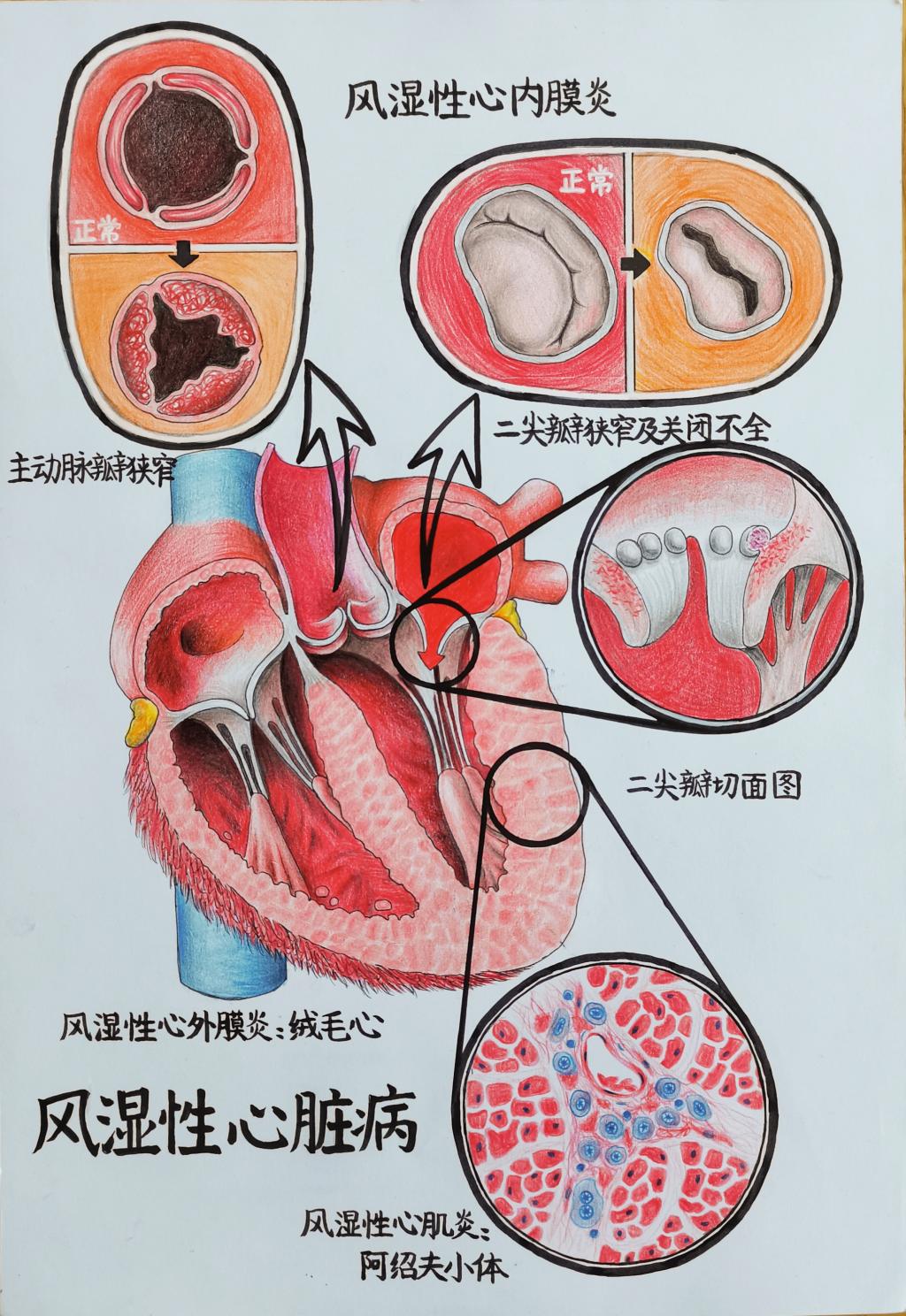2. 邮寄手绘 作品分类 2 风湿性心脏病 VSport 张晨彤